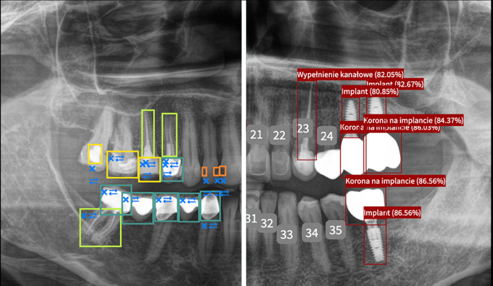 Pantomonitoring — analiza pantomogramu